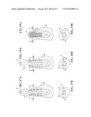 FLUTED OSTEOTOME AND SURGICAL METHOD FOR USE diagram and image