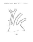 DUAL ENDOVASCULAR FILTER AND METHODS OF USE diagram and image