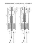 EMBOLIC PROTECTION SYSTEM diagram and image