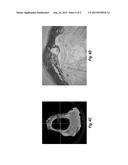 BIOMATERIAL BASED ON ALIGNED FIBERS, ARRANGED IN A GRADIENT INTERFACE,     WITH MECHANICAL REINFORCEMENT FOR TRACHEAL REGENERATION AND REPAIR diagram and image