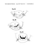 METHODS FOR REPAIR OF ABNORMAL MITRAL VALVES diagram and image