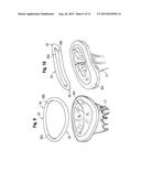 METHODS FOR REPAIR OF ABNORMAL MITRAL VALVES diagram and image