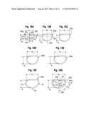 METHODS FOR REPAIR OF ABNORMAL MITRAL VALVES diagram and image