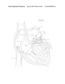 COILED ANCHOR FOR SUPPORTING PROSTHETIC HEART VALVE, PROSTHETIC HEART     VALVE, AND DEPLOYMENT DEVICE diagram and image