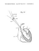 PROSTHETIC HEART VALVE, SYSTEM, AND METHOD diagram and image