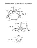 PROSTHETIC HEART VALVE, SYSTEM, AND METHOD diagram and image