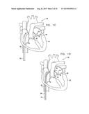 TISSUE ANCHOR FOR ANNULOPLASTY DEVICE diagram and image