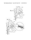 TISSUE ANCHOR FOR ANNULOPLASTY DEVICE diagram and image