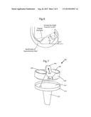 POSTERIOR STABILIZED KNEE PROSTHESIS diagram and image