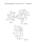 SYSTEM AND METHOD FOR IMPLATING A SECONDARY GLENOID PROSTHESIS diagram and image