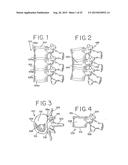 SPINAL TISSUE DISTRACTION DEVICES diagram and image