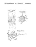 SPINAL TISSUE DISTRACTION DEVICES diagram and image