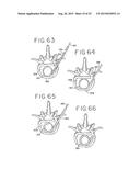 SPINAL TISSUE DISTRACTION DEVICES diagram and image