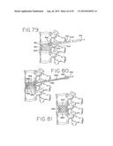SPINAL TISSUE DISTRACTION DEVICES diagram and image