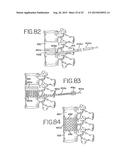 SPINAL TISSUE DISTRACTION DEVICES diagram and image