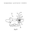 FACET JOINT REPLACEMENT diagram and image