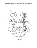 FACET JOINT REPLACEMENT diagram and image