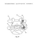 FACET JOINT REPLACEMENT diagram and image