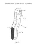 FACET JOINT REPLACEMENT diagram and image