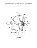 FACET JOINT REPLACEMENT diagram and image