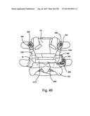 FACET JOINT REPLACEMENT diagram and image