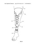 ADJUSTABLE PROSTHETIC LIMB SYSTEM diagram and image