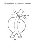 STENT/GRAFT ASSEMBLY diagram and image