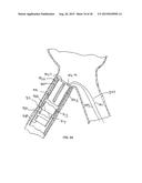 STENT/GRAFT ASSEMBLY diagram and image