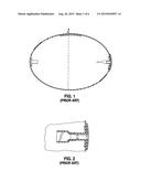 Method of Implanting an Intragastric Balloon diagram and image