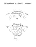 Nasal Dilator diagram and image