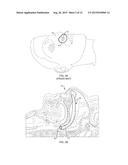 Nasopharyngeal Device for Obstructive Sleep Apnea Syndrome diagram and image