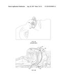 Nasopharyngeal Device for Obstructive Sleep Apnea Syndrome diagram and image