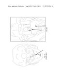 Nasopharyngeal Device for Obstructive Sleep Apnea Syndrome diagram and image