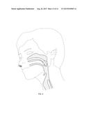 Nasopharyngeal Device for Obstructive Sleep Apnea Syndrome diagram and image