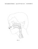 Nasopharyngeal Device for Obstructive Sleep Apnea Syndrome diagram and image