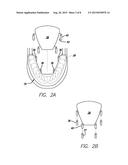 Dental Sleep Apnea Device diagram and image