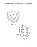 Dental Sleep Apnea Device diagram and image