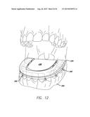 Dental Sleep Apnea Device diagram and image