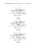 EYE TREATMENT SYSTEM WITH FLUIDICS PUMP INTERFACE diagram and image