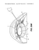 MODULAR INTRAOCULAR LENS DESIGNS, TOOLS AND METHODS diagram and image