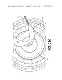 MODULAR INTRAOCULAR LENS DESIGNS, TOOLS AND METHODS diagram and image