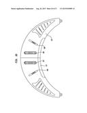 External Ear Canal Pressure Regulation System diagram and image