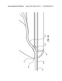 Catheter Placement Device Including Guidewire and Catheter Control     Elements diagram and image