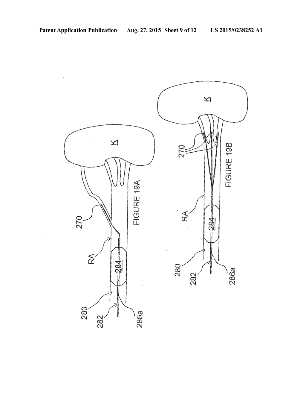 Methods and Apparatus for Renal Neuromodulation - diagram, schematic, and image 10