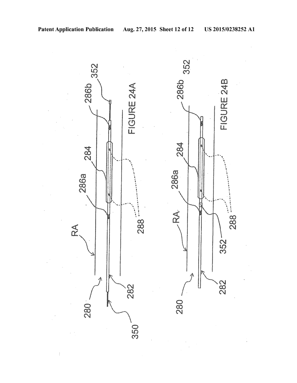 Methods and Apparatus for Renal Neuromodulation - diagram, schematic, and image 13