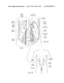 APPARATUS, SYSTEMS, AND METHODS FOR ACHIEVING INTRAVASCULAR,     THERMALLY-INDUCED RENAL NEUROMODULATION diagram and image