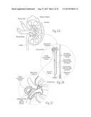 APPARATUS, SYSTEMS, AND METHODS FOR ACHIEVING INTRAVASCULAR,     THERMALLY-INDUCED RENAL NEUROMODULATION diagram and image