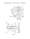 APPARATUS, SYSTEMS, AND METHODS FOR ACHIEVING INTRAVASCULAR,     THERMALLY-INDUCED RENAL NEUROMODULATION diagram and image