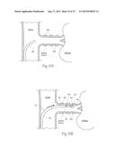 APPARATUS, SYSTEMS, AND METHODS FOR ACHIEVING INTRAVASCULAR,     THERMALLY-INDUCED RENAL NEUROMODULATION diagram and image