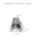 SYSTEMS AND METHODS FOR DETERMINING THE MECHANICAL AXIS OF A FEMUR diagram and image